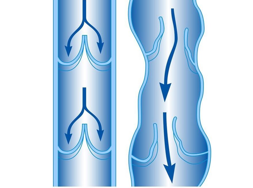 terved ja veenilaiendid